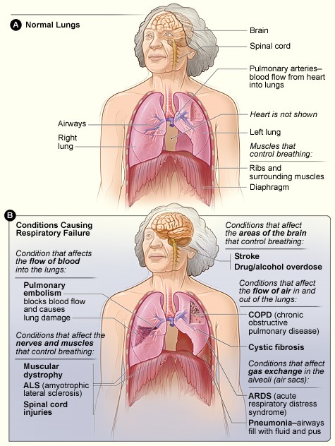 respiratory_failure.jpg