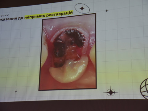 Випускник ПДМУ презентує нову методику протезування зубів